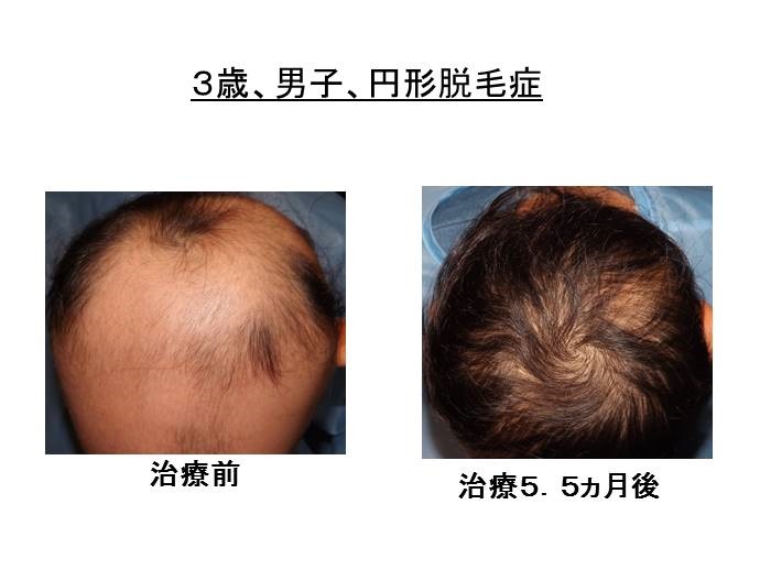 円形脱毛症　名医""